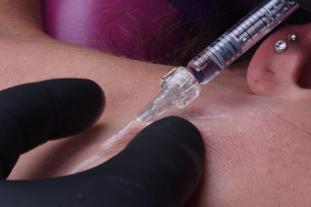Tratamiento de labios con ácido hialurónico en odontología