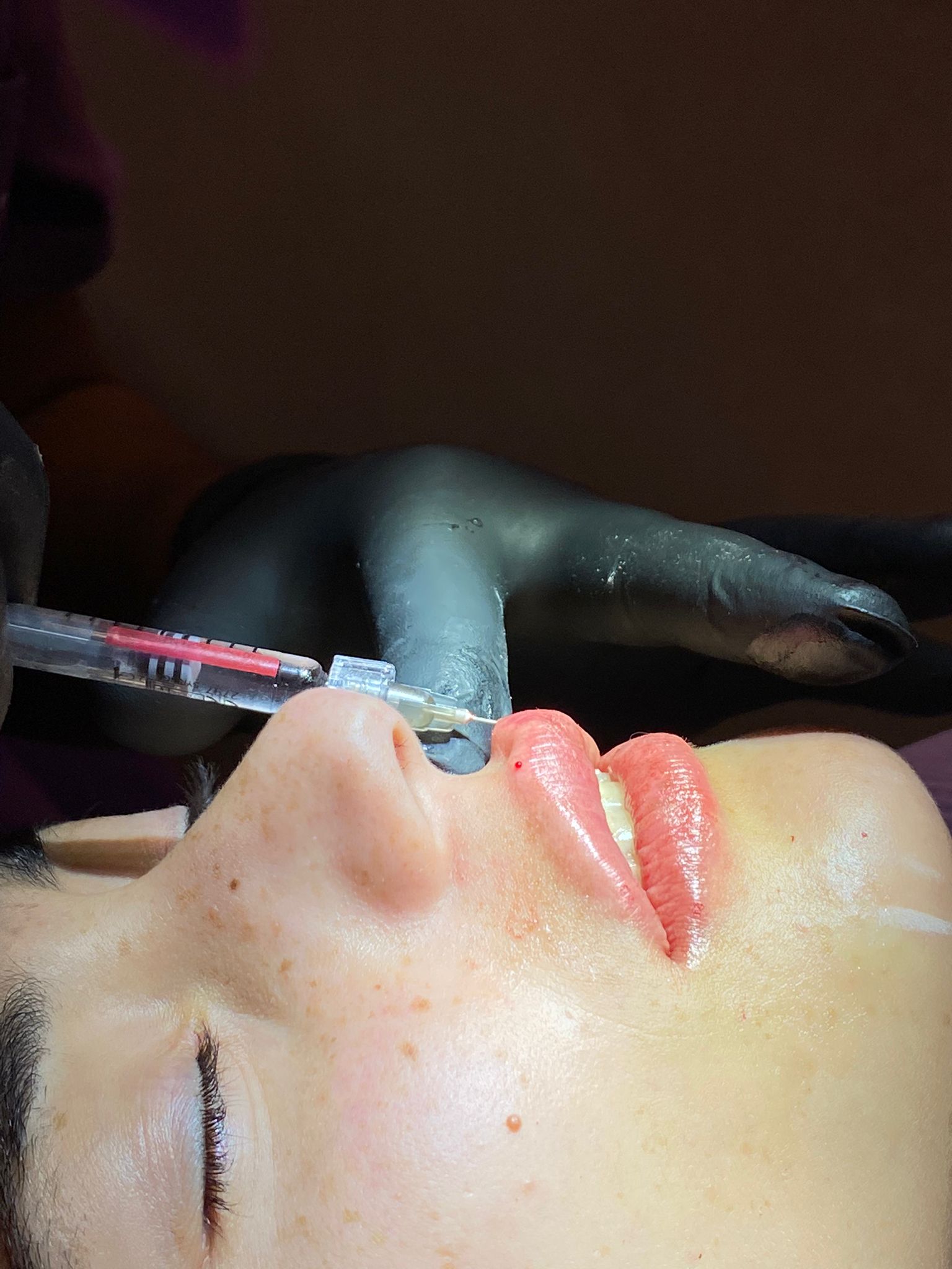 Doctro romero injectando hacido hialuronico