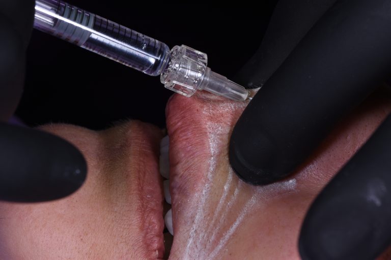 CURSO AVANZADO DE CORRECCIÓN DE SONRISA GINGIVAL